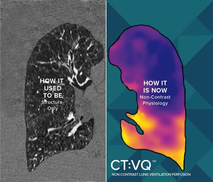 ctvq lung imaging comparison showing traditional structure imaging versus non contrast functional analysis